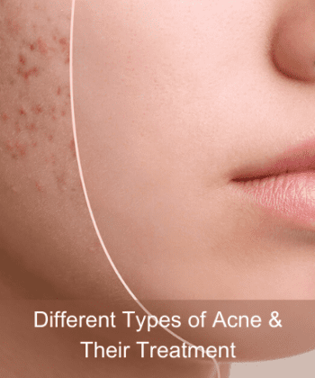 Different Types of Acne & Their Treatment